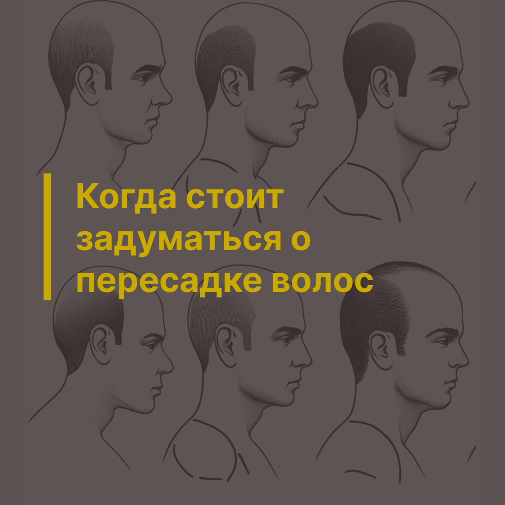Когда стоит задуматься о пересадке волос