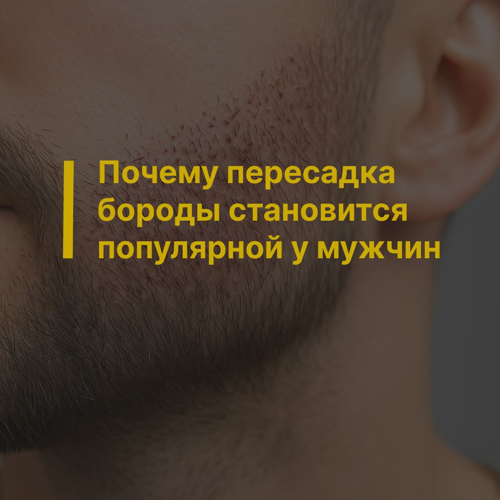 Почему пересадка бороды становится популярной у мужчин