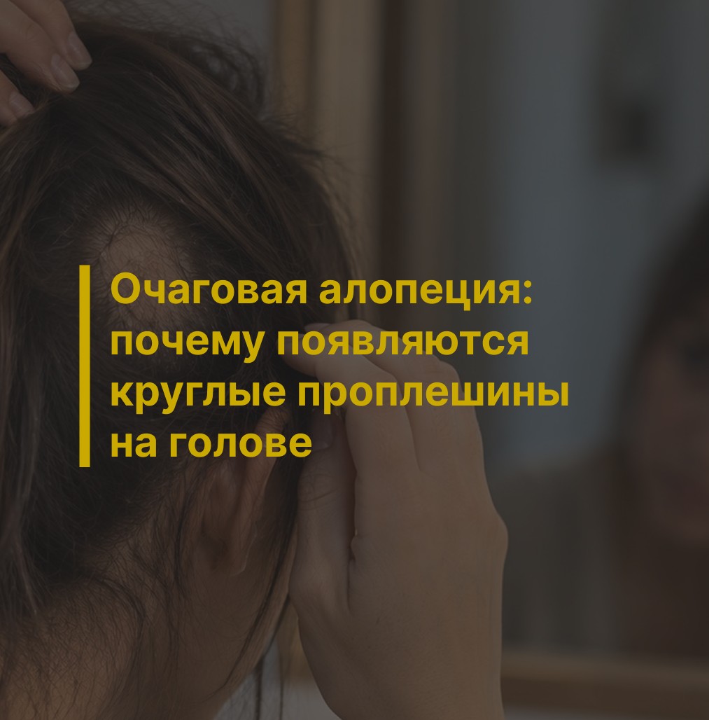 Очаговая алопеция: почему появляются круглые проплешины на голове